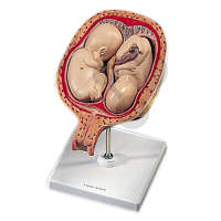 Fœtus jumeaux à 5 mois, position normale Premium